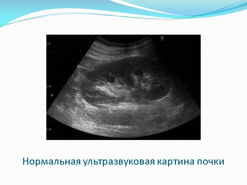 Нормальная ультразвуковая картина почки